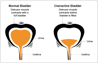 Overactive Bladder Never Allows the Bladder to Fill Completely