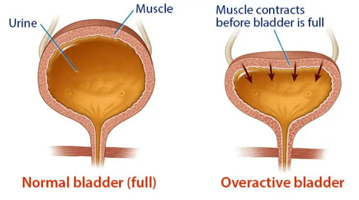 Overactive Bladder (OAB) – Female 1 Oab 1